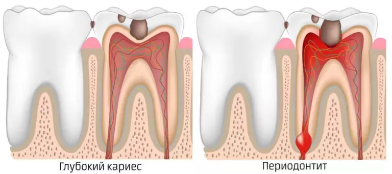 лікування періодонтиту